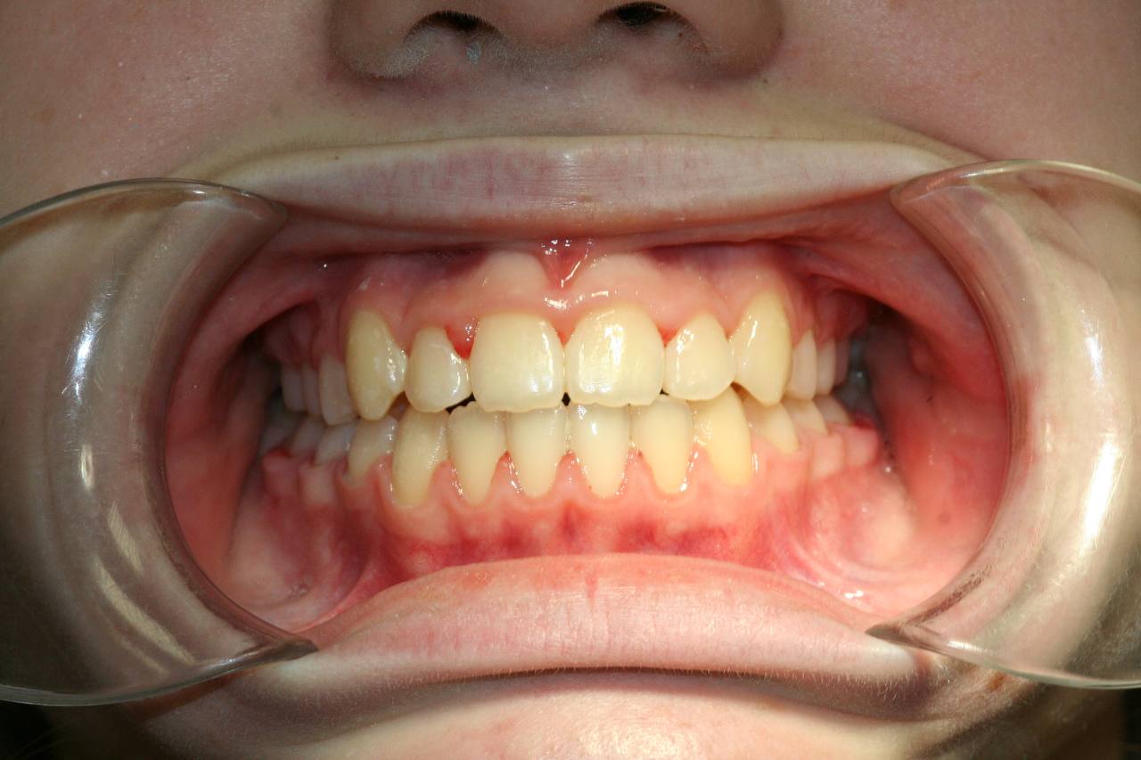 После лечения