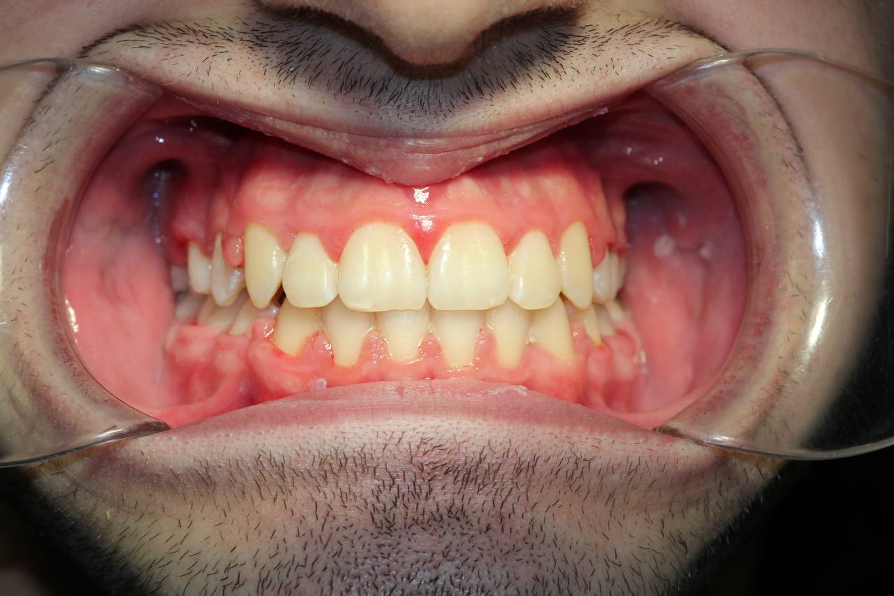 После лечения