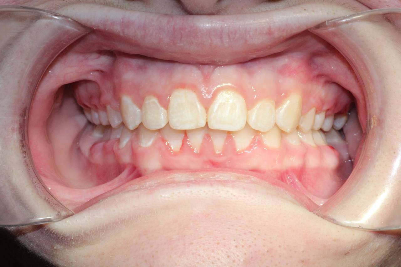 После лечения